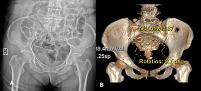 Sacroiliac screws fixation navigated with three-dimensional printing personalized guide template for the treatment of posterior pelvic ring injury: A case report